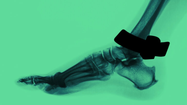 Ankle X-ray showing calcaneus heel bone securing GPS ankle monitor - bone structure prevents device removal