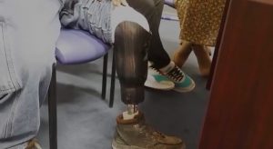 Asylum seeker with prosthetic leg after ankle monitor caused amputation in Indiana - ICE electronic monitoring safety crisis