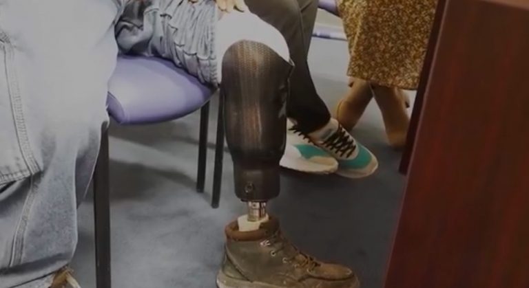 Asylum seeker with prosthetic leg after ankle monitor caused amputation in Indiana - ICE electronic monitoring safety crisis